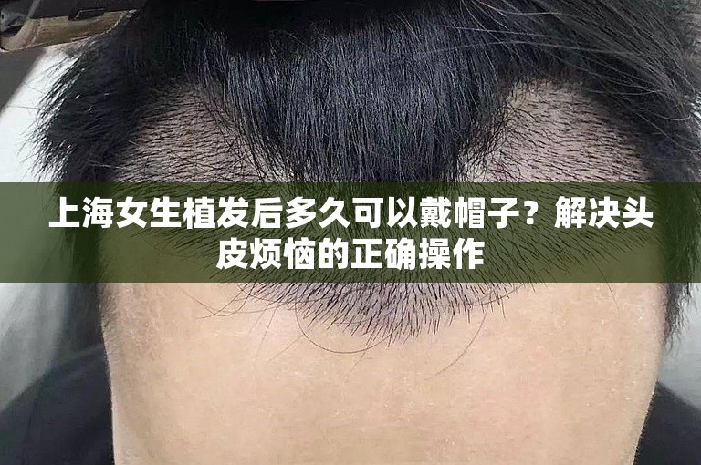 上海女生植发后多久可以戴帽子？解决头皮烦恼的正确操作