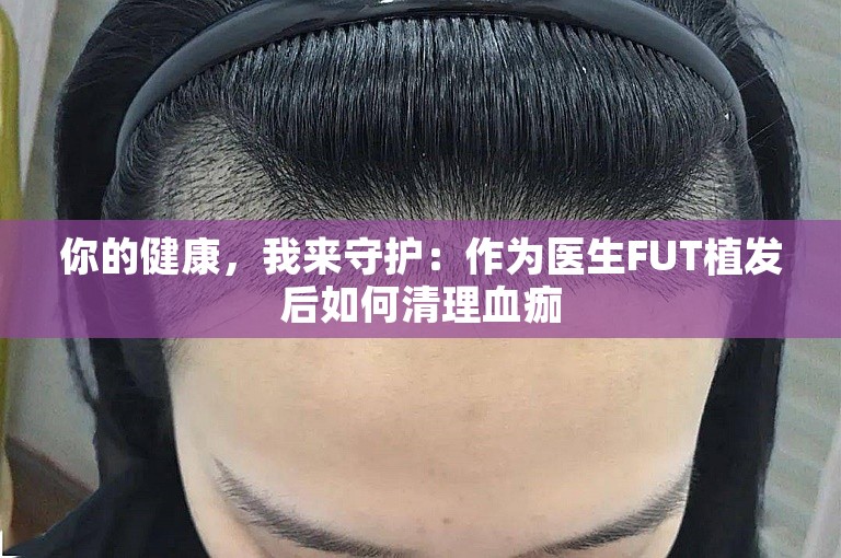 你的健康，我来守护：作为医生FUT植发后如何清理血痂