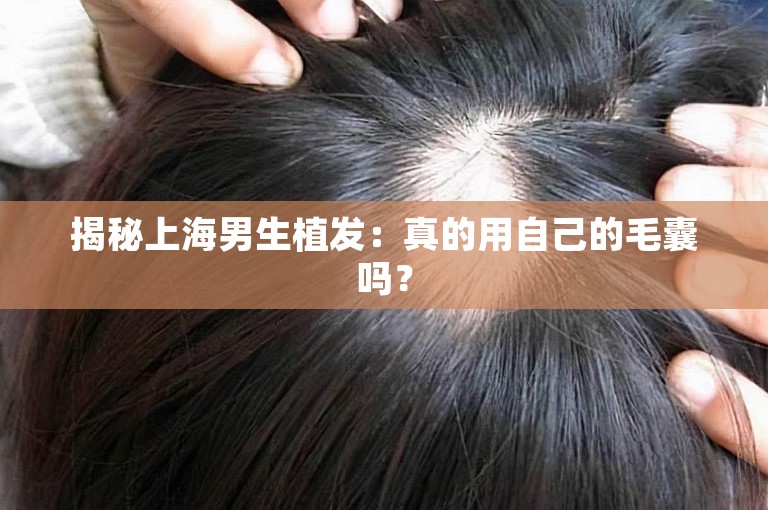 揭秘上海男生植发：真的用自己的毛囊吗？