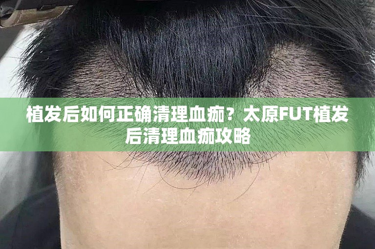 植发后如何正确清理血痂？太原FUT植发后清理血痂攻略