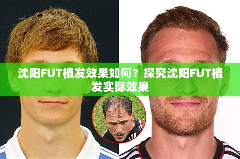 沈阳FUT植发效果如何？探究沈阳FUT植发实际效果