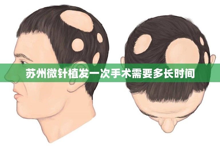 苏州微针植发一次手术需要多长时间