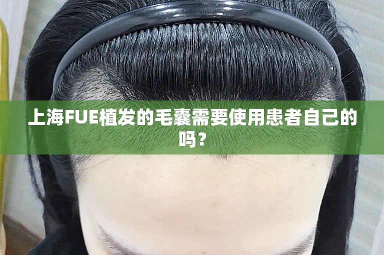 上海FUE植发的毛囊需要使用患者自己的吗？