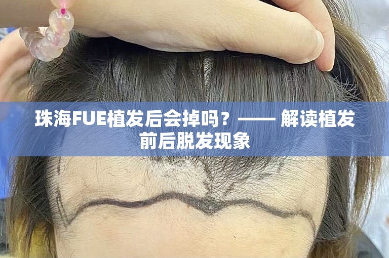 珠海FUE植发后会掉吗？—— 解读植发前后脱发现象