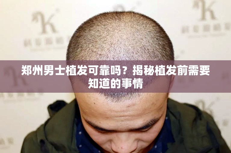 郑州男士植发可靠吗？揭秘植发前需要知道的事情