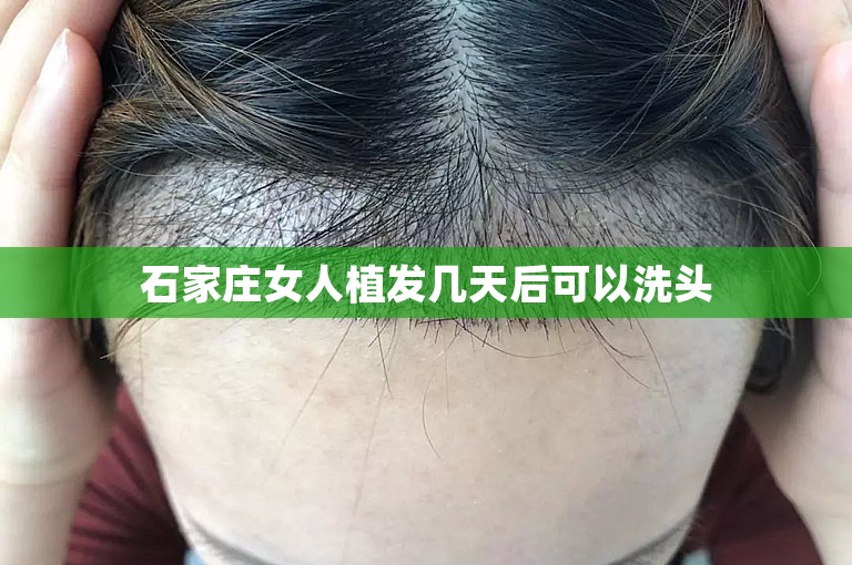 石家庄女人植发几天后可以洗头