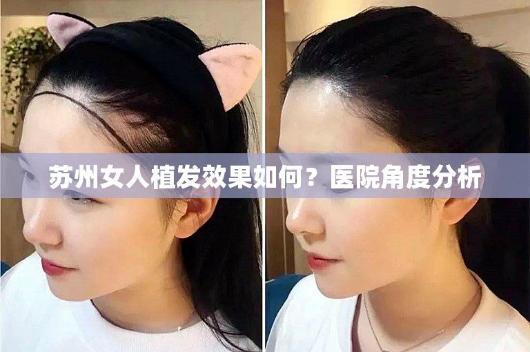 苏州女人植发效果如何？医院角度分析