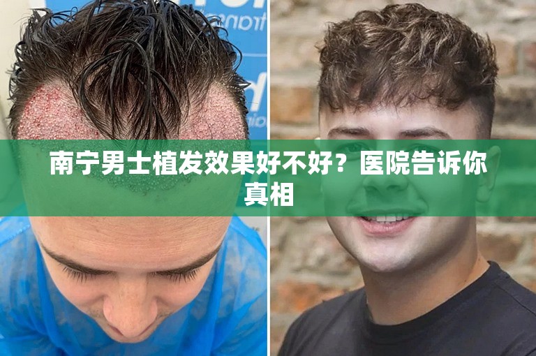 南宁男士植发效果好不好？医院告诉你真相