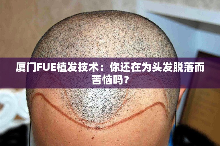 厦门FUE植发技术：你还在为头发脱落而苦恼吗？