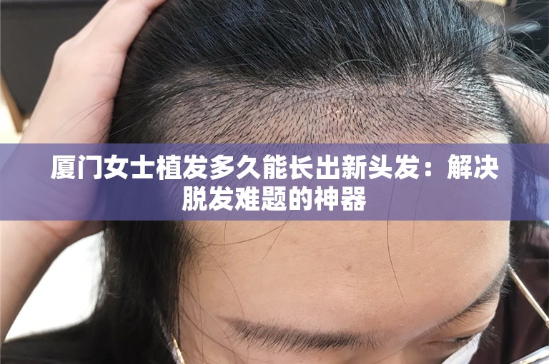 厦门女士植发多久能长出新头发：解决脱发难题的神器