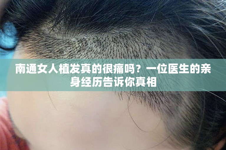 南通女人植发真的很痛吗？一位医生的亲身经历告诉你真相