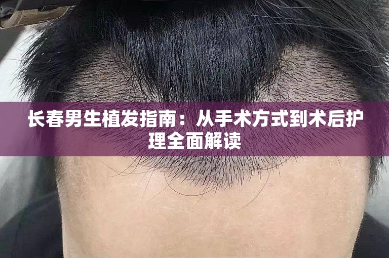 长春男生植发指南：从手术方式到术后护理全面解读