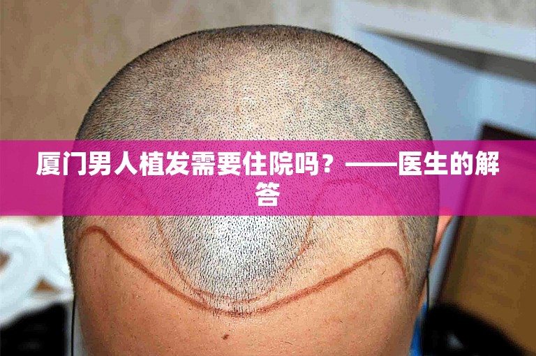 厦门男人植发需要住院吗？——医生的解答