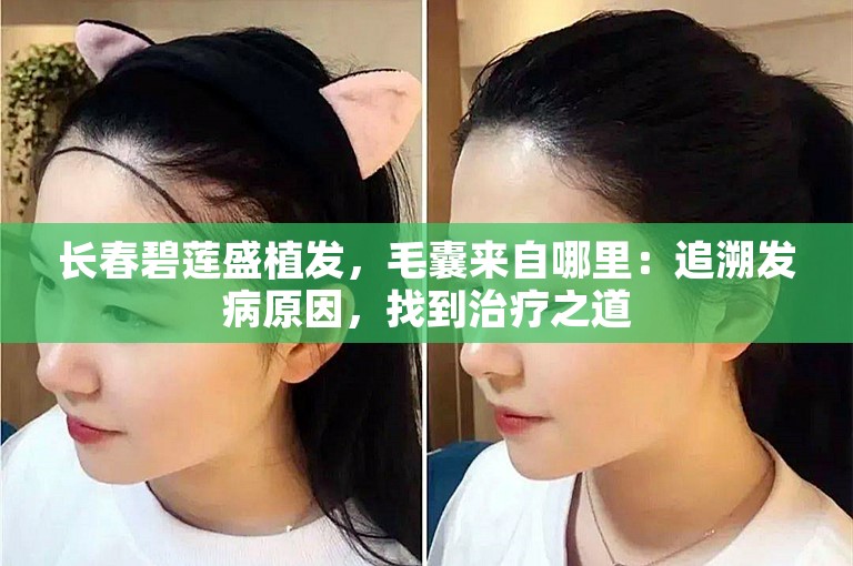 长春碧莲盛植发，毛囊来自哪里：追溯发病原因，找到治疗之道