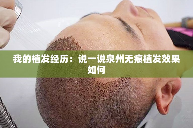 我的植发经历：说一说泉州无痕植发效果如何