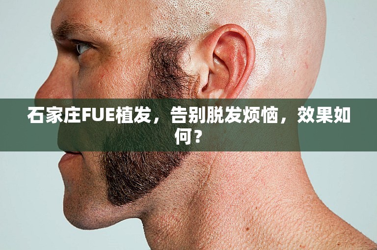 石家庄FUE植发，告别脱发烦恼，效果如何？