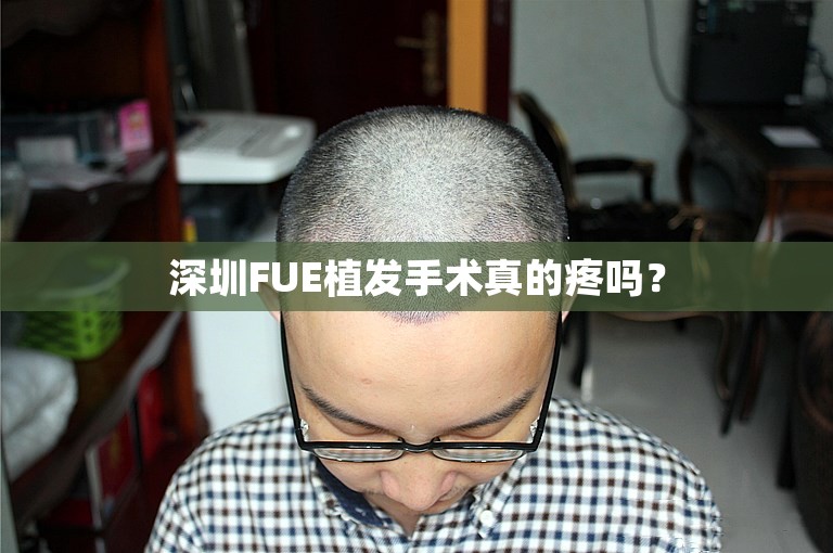 深圳FUE植发手术真的疼吗？