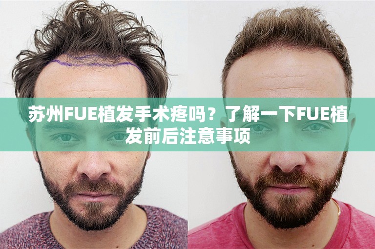 苏州FUE植发手术疼吗？了解一下FUE植发前后注意事项