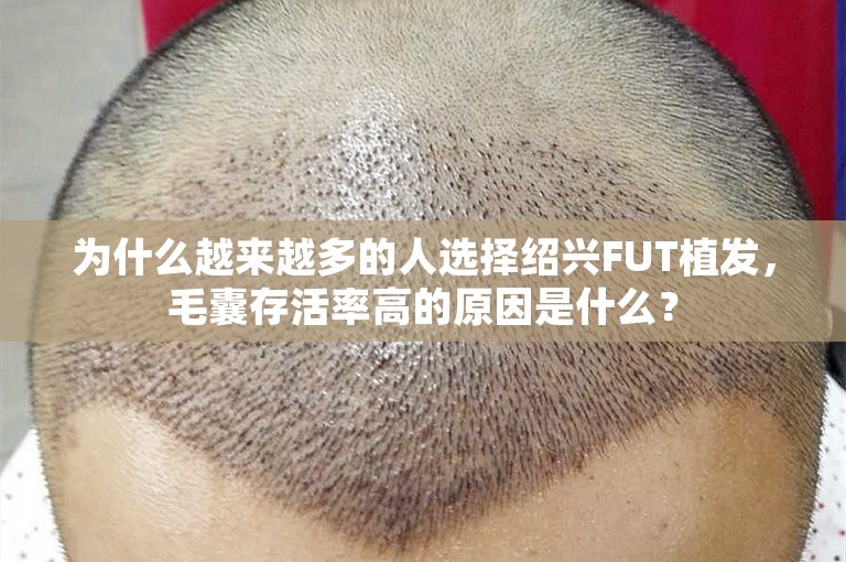 为什么越来越多的人选择绍兴FUT植发，毛囊存活率高的原因是什么？