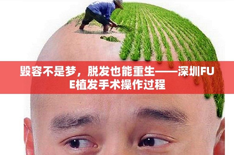 毁容不是梦，脱发也能重生——深圳FUE植发手术操作过程