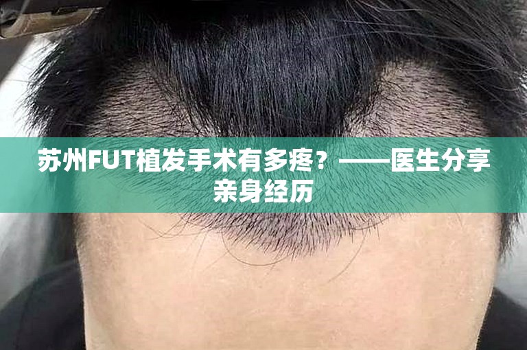 苏州FUT植发手术有多疼？——医生分享亲身经历