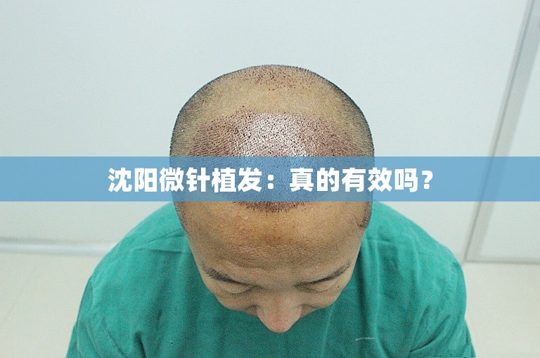 沈阳微针植发：真的有效吗？