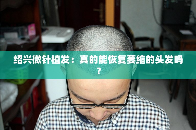 绍兴微针植发：真的能恢复萎缩的头发吗？