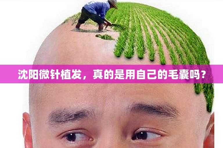 沈阳微针植发，真的是用自己的毛囊吗？