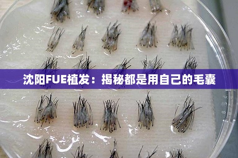 沈阳FUE植发：揭秘都是用自己的毛囊