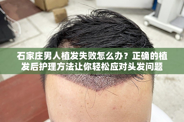 石家庄男人植发失败怎么办？正确的植发后护理方法让你轻松应对头发问题