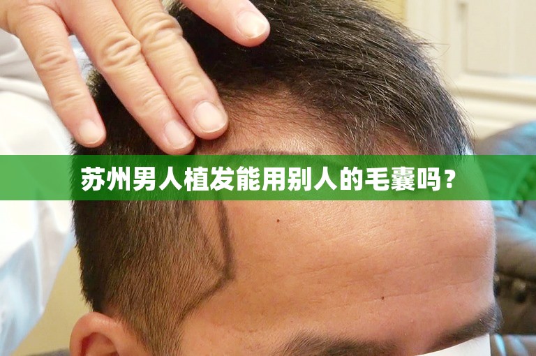 苏州男人植发能用别人的毛囊吗？