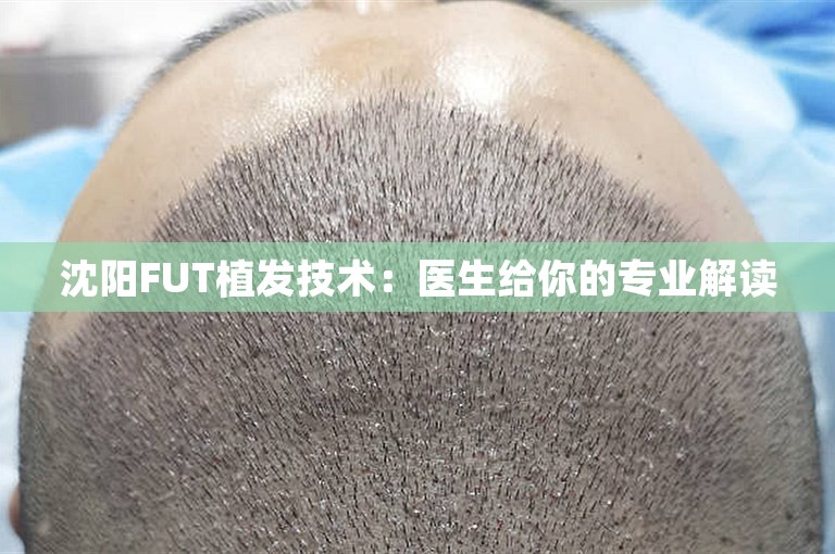 沈阳FUT植发技术：医生给你的专业解读