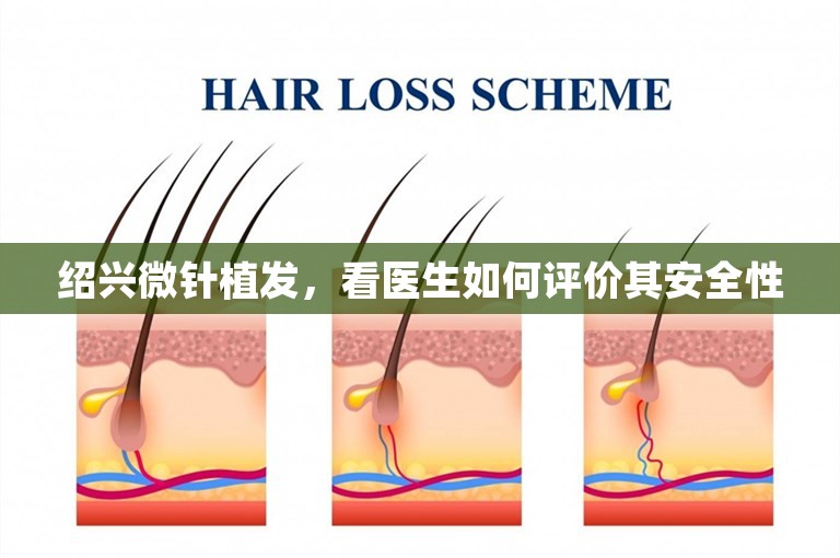 绍兴微针植发，看医生如何评价其安全性