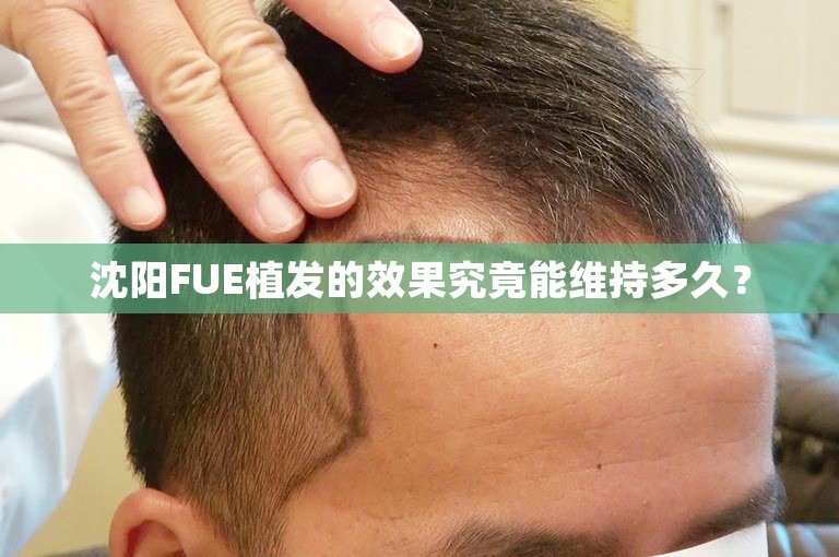 沈阳FUE植发的效果究竟能维持多久？