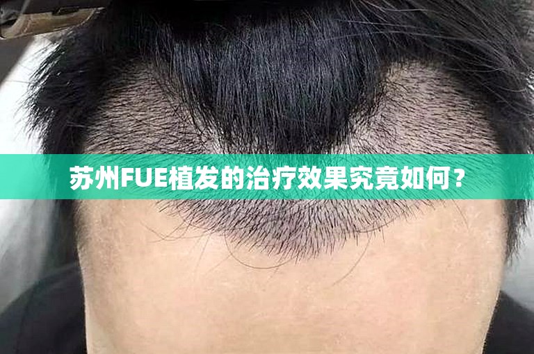 苏州FUE植发的治疗效果究竟如何？