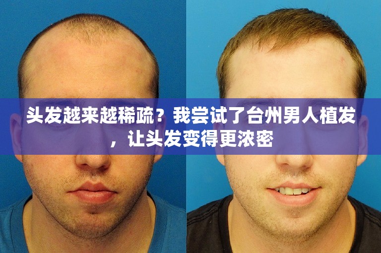 头发越来越稀疏？我尝试了台州男人植发，让头发变得更浓密