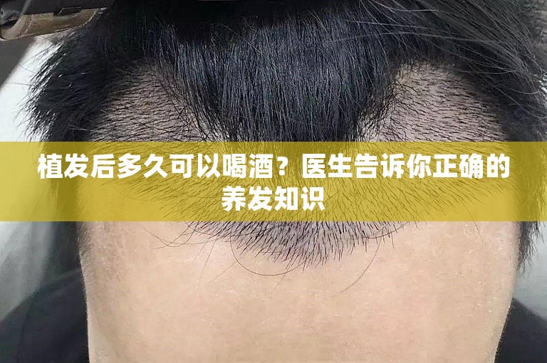 植发后多久可以喝酒？医生告诉你正确的养发知识