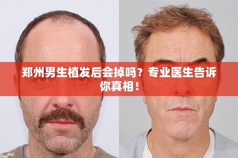 郑州男生植发后会掉吗？专业医生告诉你真相！