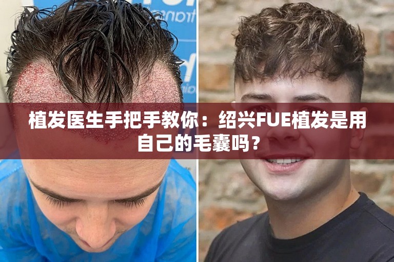 植发医生手把手教你：绍兴FUE植发是用自己的毛囊吗？