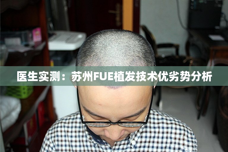 医生实测：苏州FUE植发技术优劣势分析