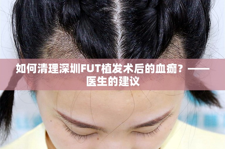 如何清理深圳FUT植发术后的血痂？——医生的建议