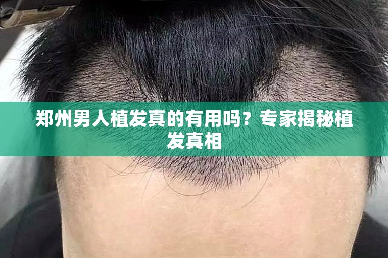 郑州男人植发真的有用吗？专家揭秘植发真相