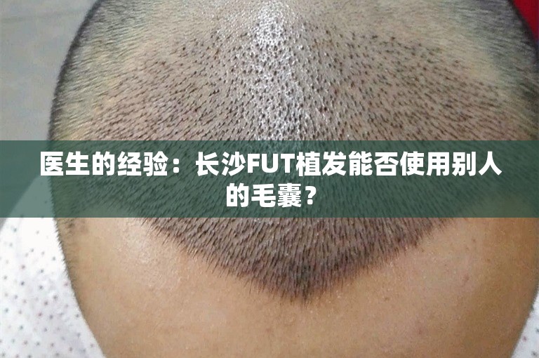 医生的经验：长沙FUT植发能否使用别人的毛囊？