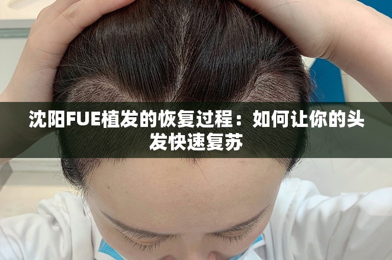 沈阳FUE植发的恢复过程：如何让你的头发快速复苏