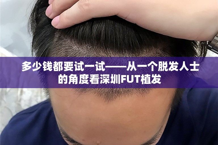  多少钱都要试一试——从一个脱发人士的角度看深圳FUT植发