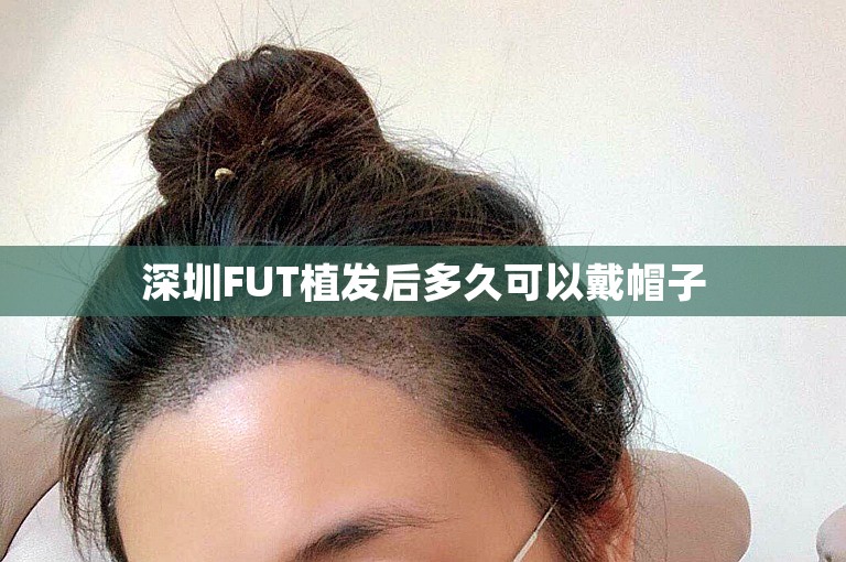 深圳FUT植发后多久可以戴帽子