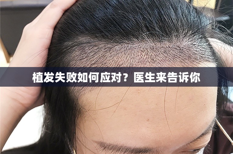 植发失败如何应对？医生来告诉你