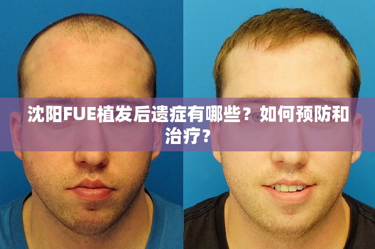 沈阳FUE植发后遗症有哪些？如何预防和治疗？