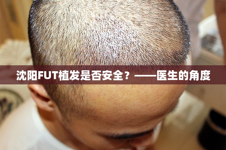 沈阳FUT植发是否安全？——医生的角度