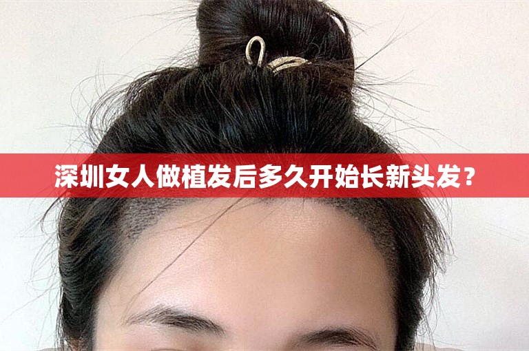 深圳女人做植发后多久开始长新头发？